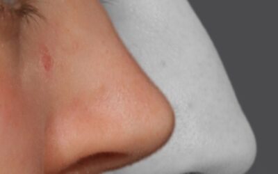 A RINOPLASTIA MODERNA EXIGE MAIS DO QUE TÉCNICA CIRÚRGICA?