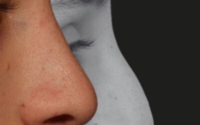 POR QUE ALGUNS PACIENTES CICATRIZAM MELHOR DO QUE OUTROS APÓS A RINOPLASTIA?